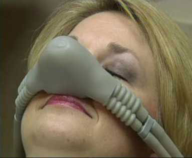 A close-up of a sleeping woman's face. She is wearing a mask delivering nitrous oxide, a sedative for some dental emergencies.