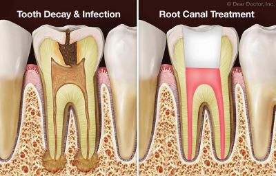 An illustration of a tooth before and after a root canal, a common dental emergency procedure.
