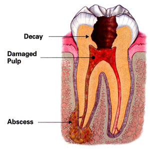 An illustration of a toothache caused by infection. Arrows indicated decay and damaged pulp in the tooth and an abscess at one of the two tooth roots.