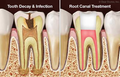 On the left, an illustration of a tooth with decay and infection. The infection extrudes from the tooth's roots. On the right is a healthy tooth after root canal treatment. It is filled and sealed to prevent future infection.
