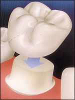 a drawing of the stub of a tooth and a tooth-colored crown being placed on it